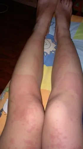 成整片的红疙瘩,红疙瘩处发热,与好皮肤界限明显.