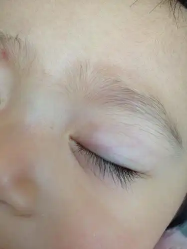 问:崽崽眼睛上突然冒出个疙瘩,像是长在眼皮里面的,表面皮肤完好,她