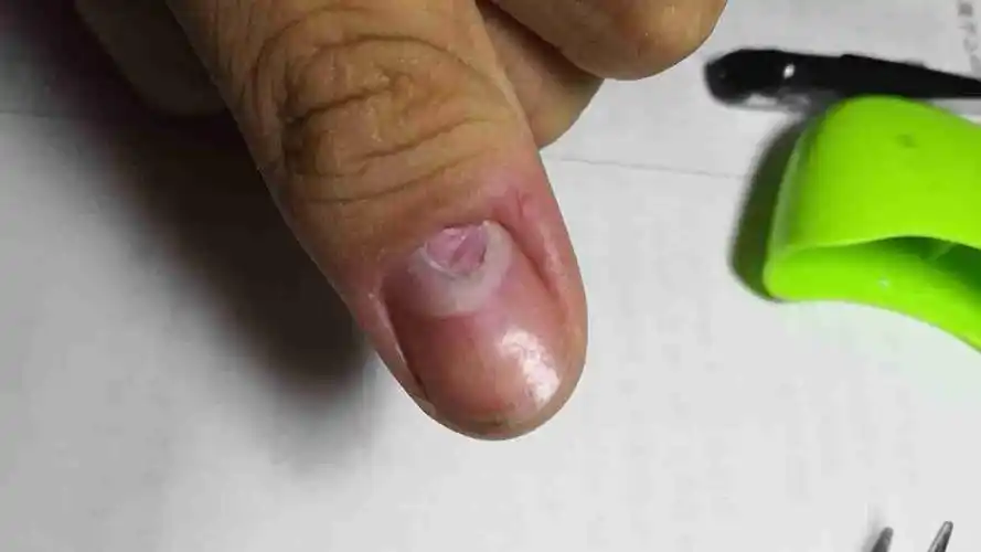 大拇指指甲,根部掉落了一小块