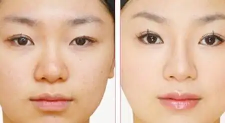 玻尿酸隆鼻前后对比图