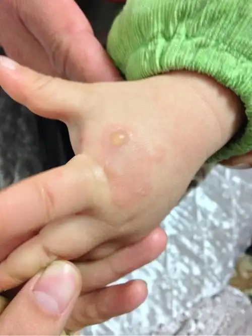 他急忙赶到儿童医院,医生询问孩子烫伤的原因和过程,校医