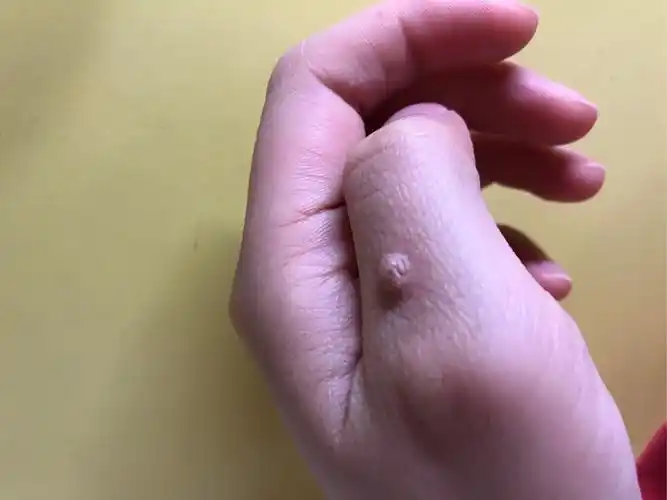 手上长了个小肉球,不知道该肿么办 求大神帮忙! - 知乎