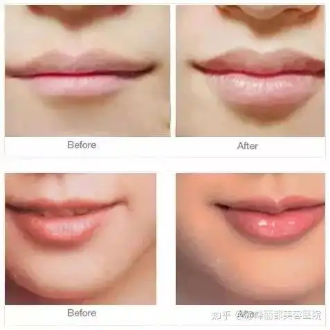 丰唇效果对比