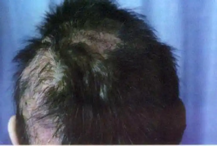 女生的头癣初期图片_有来医生