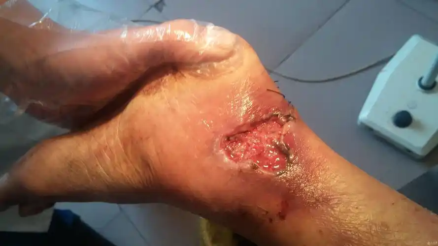 皮肤外伤后结痂发黑坏死