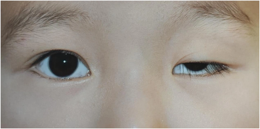 术前照片术后照片什么是先天性上睑下垂?