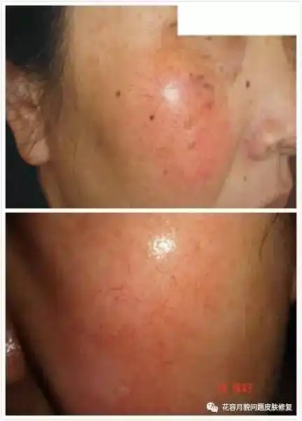 果酸换肤让你没脸见人