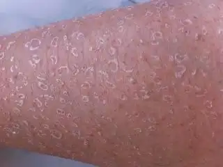 是皮肤干燥引起的还是皮肤病?