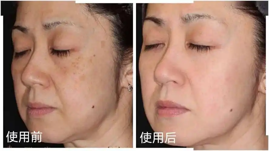 本人真实的祛斑经历每晚睡前做这事20年色斑都有救