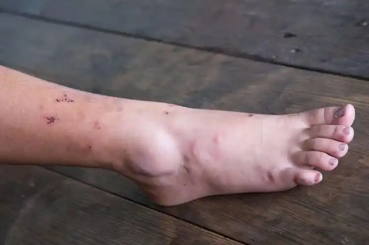 糖尿病足的早期症状