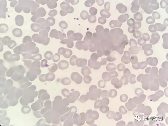 面对一份「高冷」的红细胞凝集标本,你会如何处理?