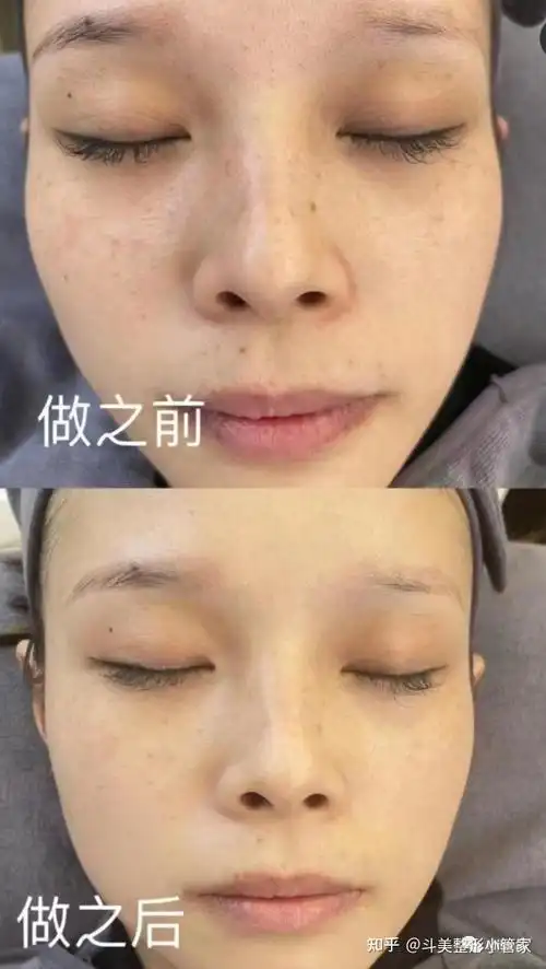 说了这么多,水光针的效果到底怎么样?