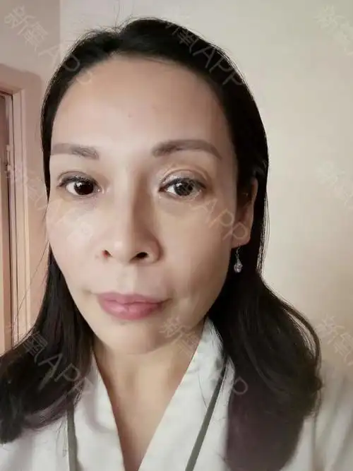 自体脂肪丰眼窝好不好_效果图_芳华00自体脂肪丰眼窝术后第7天_新氧