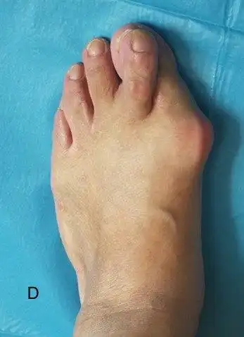 拇外翻有何危害