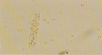 1)形态:管形中的红细胞常互相粘连而无明显的细胞界限,有的甚至残缺不