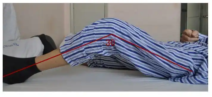 得了膝关节骨关节炎什么时候需要人工膝关节置换