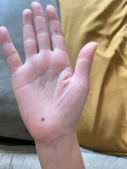 掌心的痣要切掉吗?