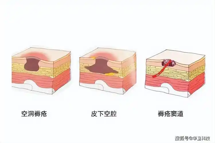 护理大讲堂 | 褥疮压疮的分期与护理方法_伤口_敷料_皮肤