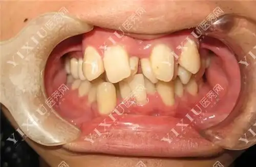 各种牙齿畸形做矫正价格表更新!-医秀网