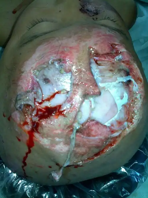 头皮撕脱伴头皮缺损