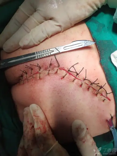 一例藏毛窦手术