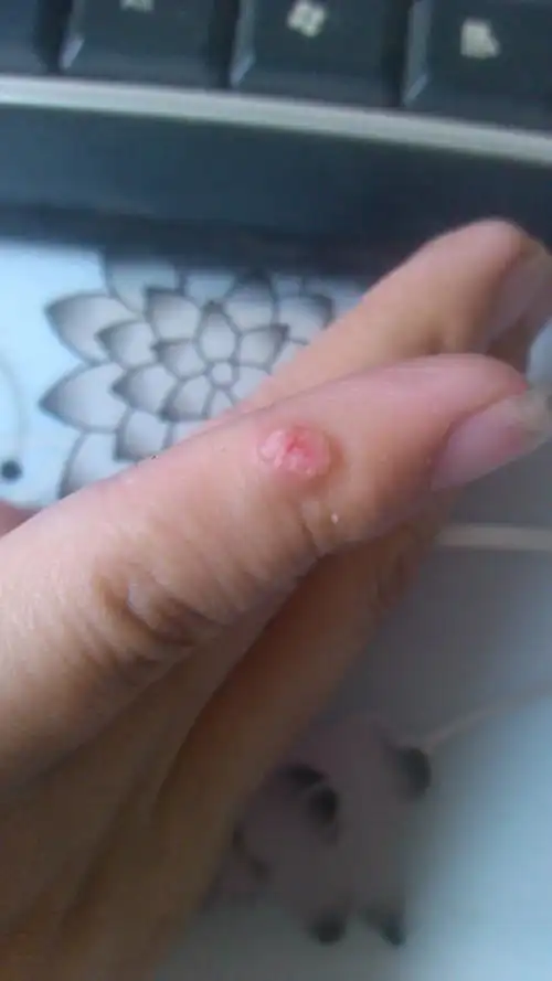 刺猴 几年了 来个亲身经历的可以么