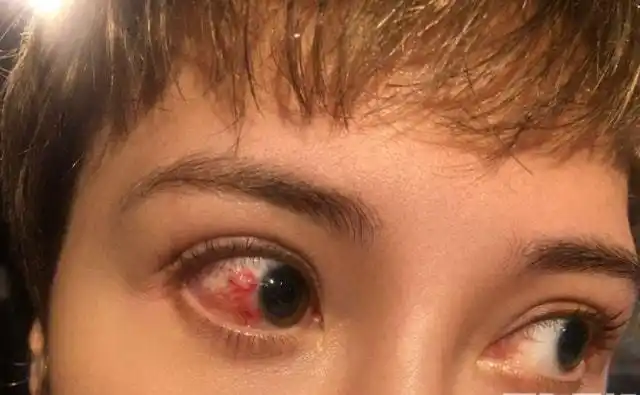 苗侨伟剧组枪战出意外,女演员眼球被弹片擦伤布满血丝|刘家良|惠英红