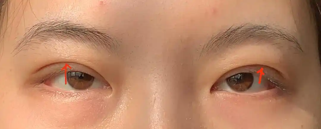 求助集美们进瘦十斤上眼皮这么厚的皮脂还