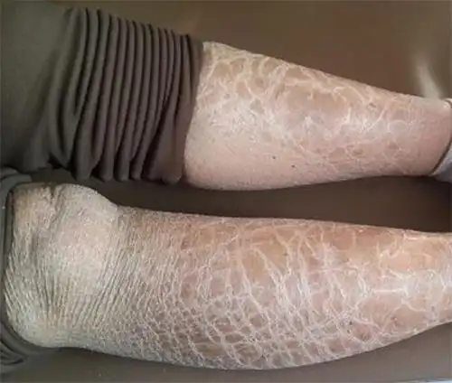 冬季皮肤瘙痒起皮屑还皮炎湿疹3大防护技巧不可不知