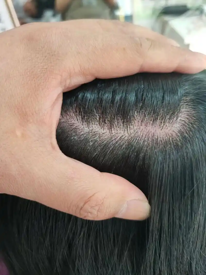 头皮屑,毛囊炎,敏感,综合性的头皮 这个顾客是一个中和性的头皮问题