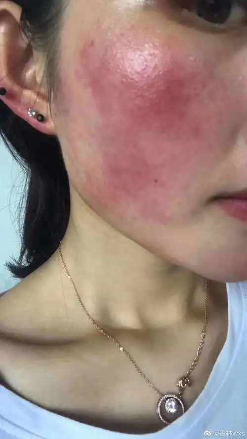 刚过敏的时候脸部发红发痒又烫,角质层严重受损
