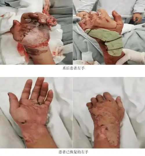 男子酒后不幸遭遇车祸左手惨遭严重碾压专家妙手仁心紧急修复