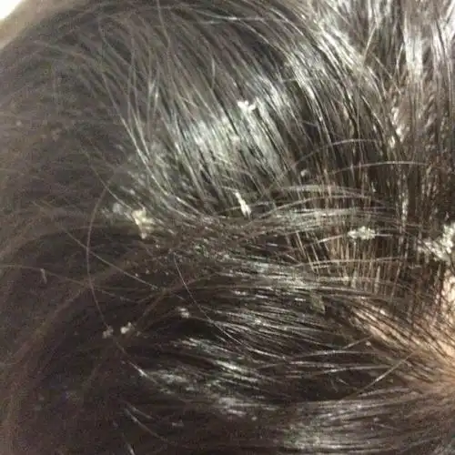 头皮屑很大块,用米醋洗的效果不持久怎么办?