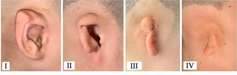小耳畸形