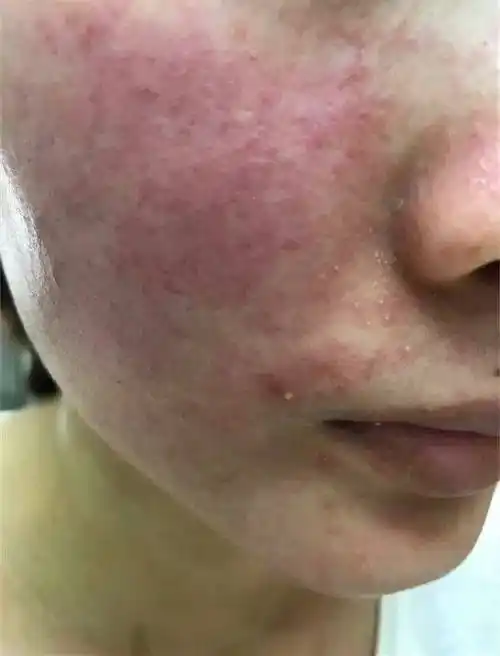 激素脸脸痒怎么办才能治好?_症状_药膏_面部