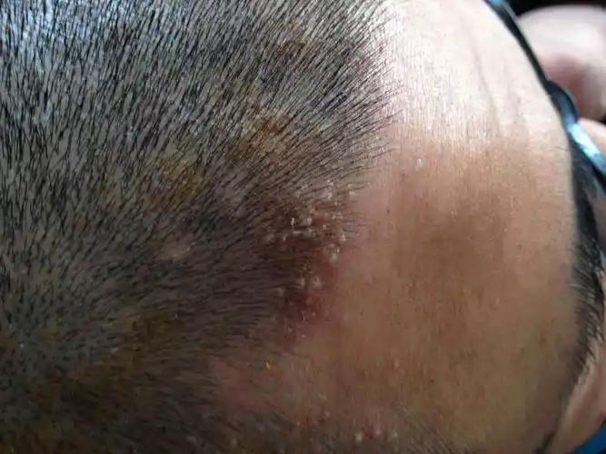 需要同仁帮助,头上反复长疙瘩