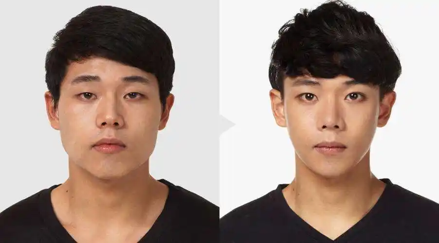 男人整容前后对比男人整形也疯狂