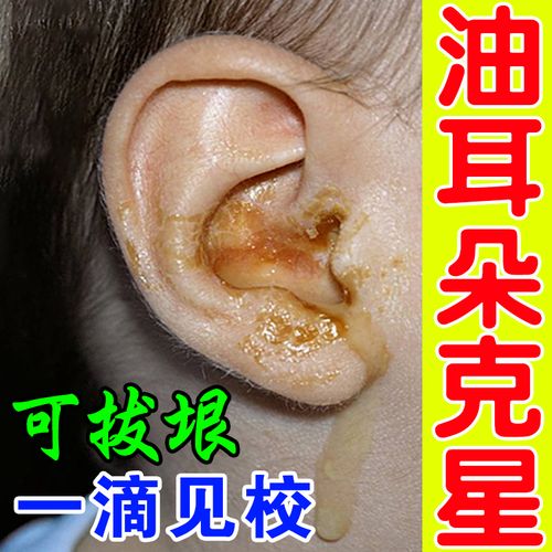 为什么会有油耳屎 有油耳朵就一定有狐臭吗
