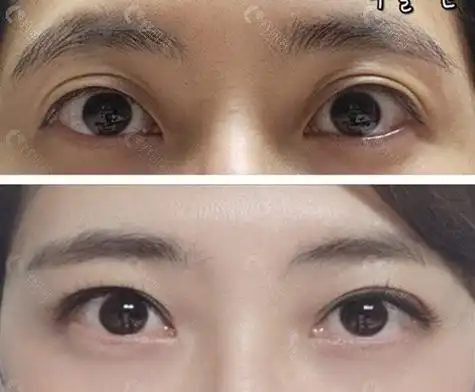 像下面这位姑娘就是因为之前做的眼部提肌手术成效不够