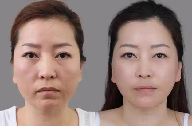 自体脂肪全面部填充对比图