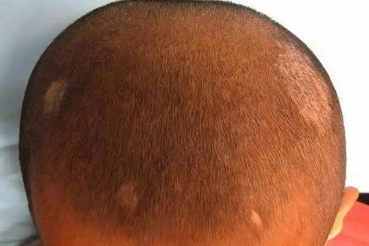 白癣病主要表现为头部出现单发或多发的白色头屑,并可伴发秃疮.