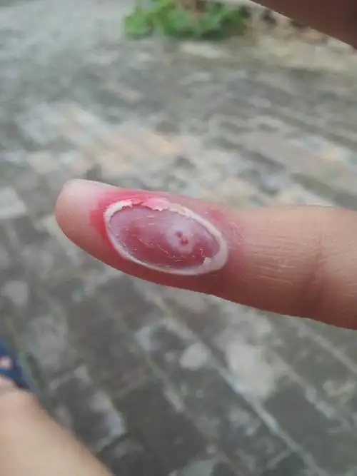 我肉刺用鸡眼贴露出嫩肉了中间还未干净还需要继续贴吗