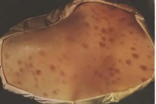 那么梅毒可以治好吗?梅毒不治疗会怎么样?追随着我了解一下吧!