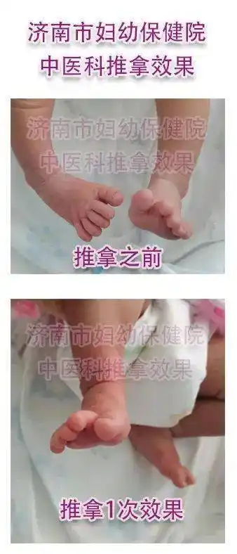 直击北京冬奥会冰墩墩其实是内八字如果宝宝内八怎么办