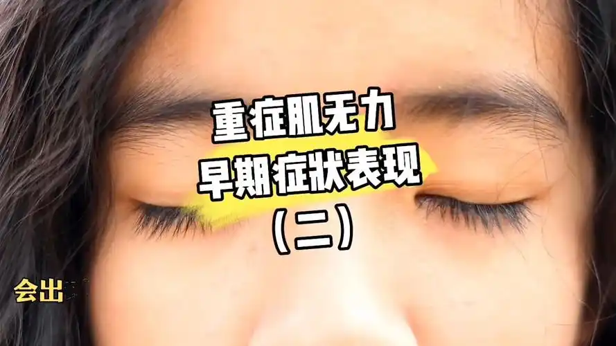 健康养生#重症肌无力的早期症状表现 (二)