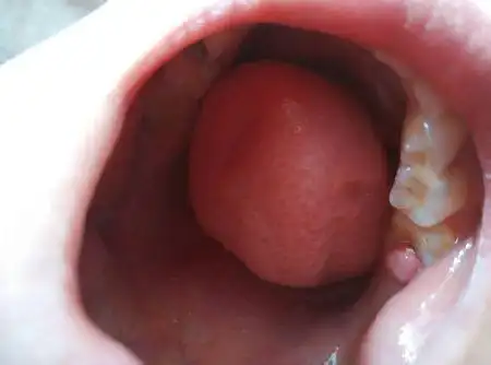 7岁孩子后牙床上长了个肉包,覆盖在旁边的大牙上,能掀起.
