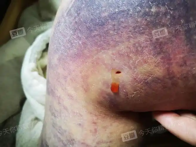 去抽脂了开个贴全程记录一下210209更新术后第18天