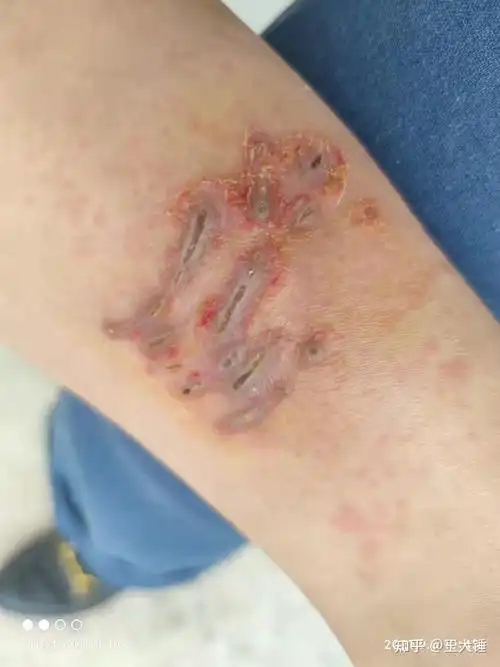 养猫被猫咬连医生都说我是他从医以来看过被猫咬的最狠的患者