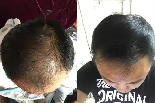 生发成功啦,生发经验分享!