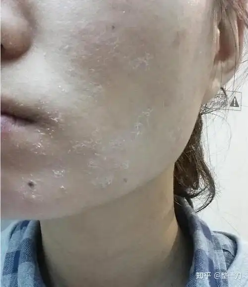 化妆品过敏后的不良症状有哪些呢? - 知乎